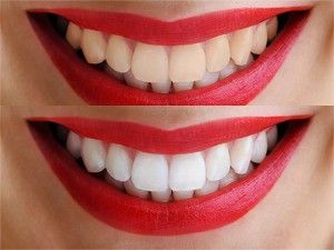 blanqueamiento dental