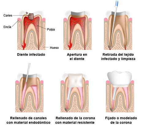 endodoncia endodoncia