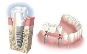 implantes Reus