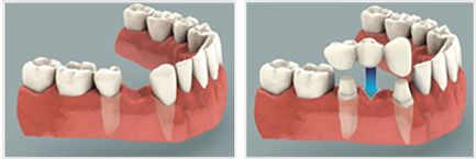 protesis dental fija protesis dental fija