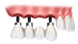 Protesis fija parcial sobre implantes Protesis fija parcial sobre implantes