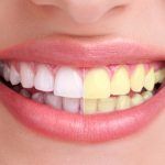 Dentista Reus Blanqueamiento dental