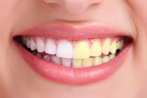 Estética Dental - Blanqueamiento Dental