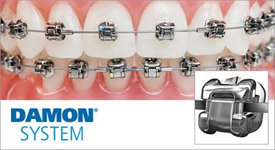 Ortodoncia brackets Sistema Damon