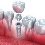 Dentista Reus Implantes