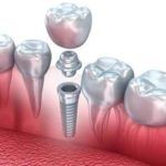 Dentista Reus Implantes