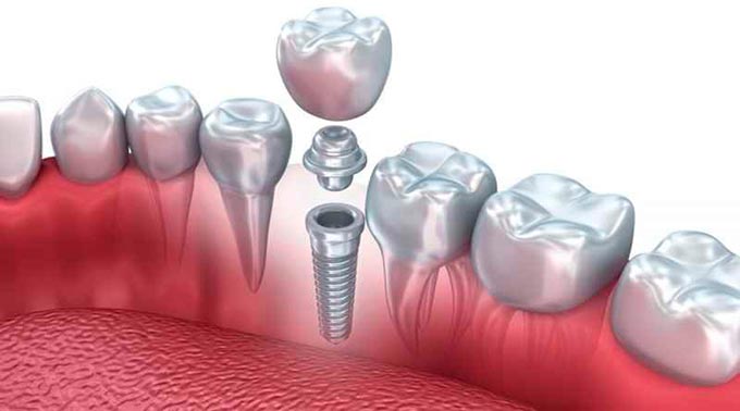 Implantes Dentales