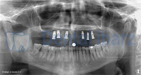 Ortopantomografía después colocación Implantes dentales Ortopantomografía implantes después