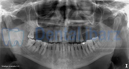 Ortopantomografía ANTES colocación Implantes dentales Ortopantomografía Implantes antes