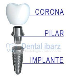 Implantes dentales