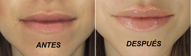 Ácido Hialurónico Labios Ácido Hialurónico Labios