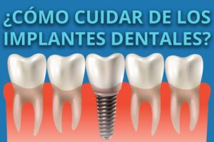 Cuidados después de un implante dental en Reus en Dental Ibarz