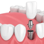 Cuidados y ventajas de los implantes dentales en Reus en Dental Ibarz