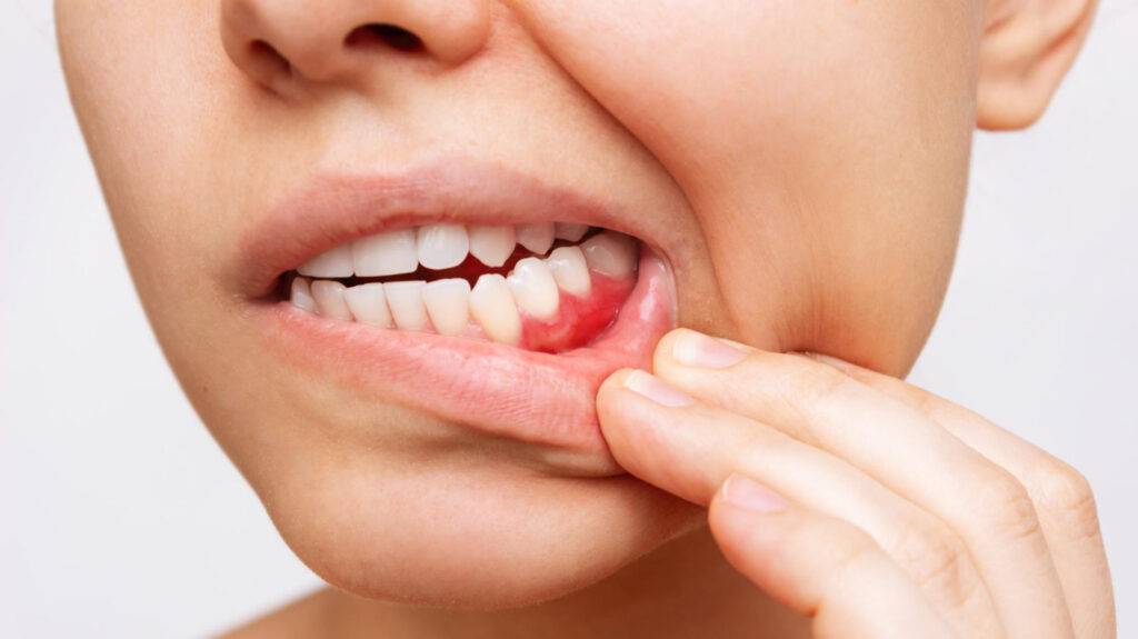 Encías inflamadas Reus - Clínica Dental Ibarz Encías inflamadas en Reus: causas y tratamiento en Dental Ibarz