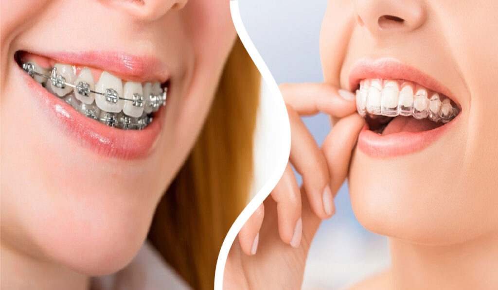 Tratamientos de ortodoncia Reus en la Clínica Dental Ibarz